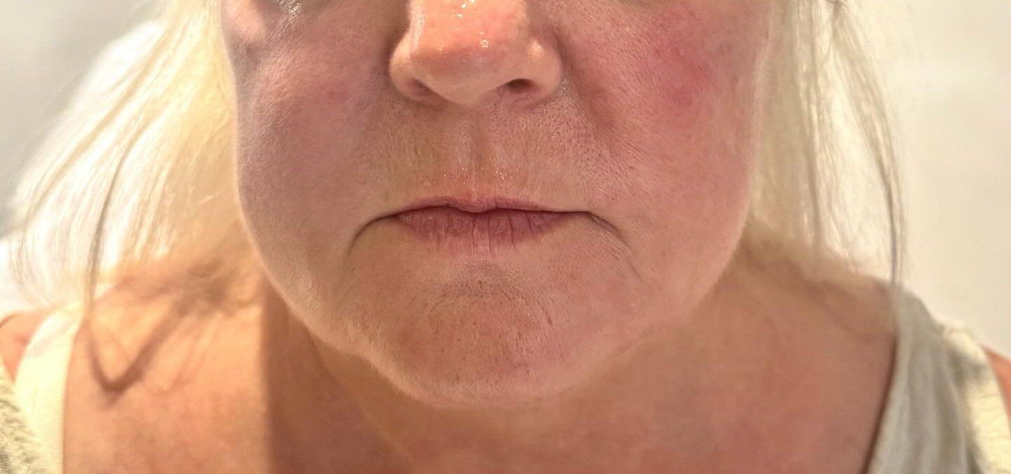 Jawline &amp; Skin — after
