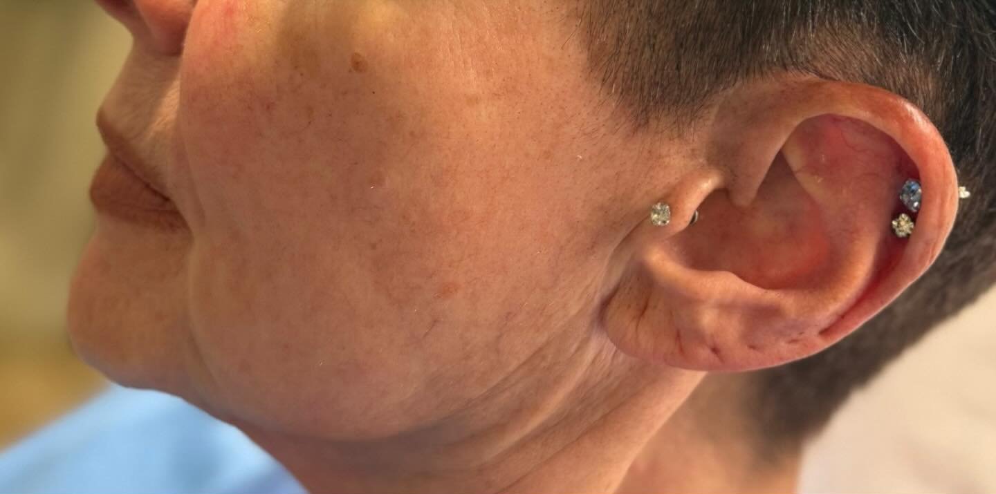 Chin Filler — before