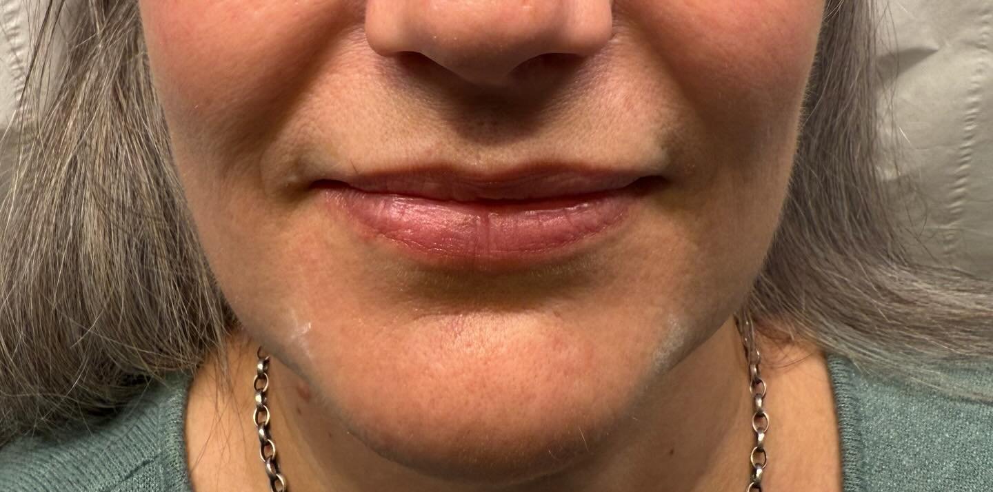 Jawline Contour — before