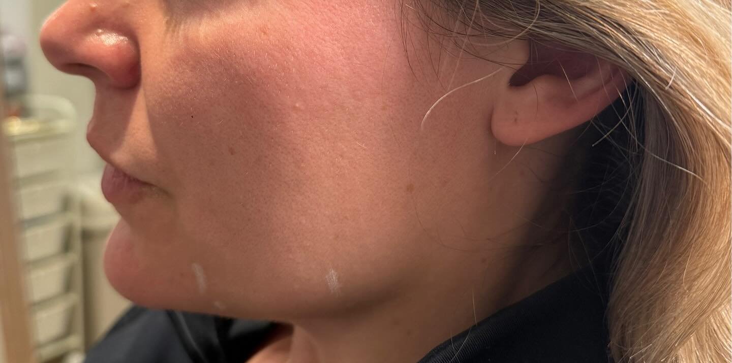 Chin Filler — before