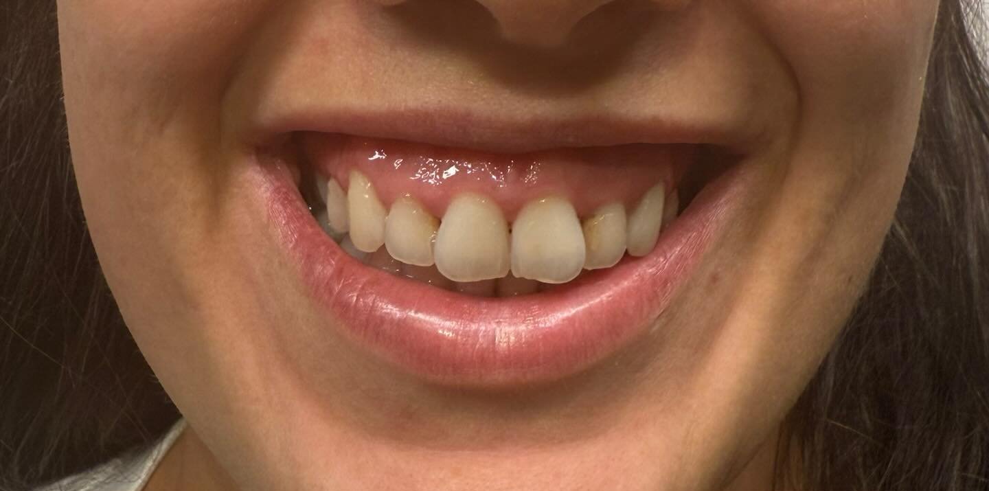 Lip Definition — before