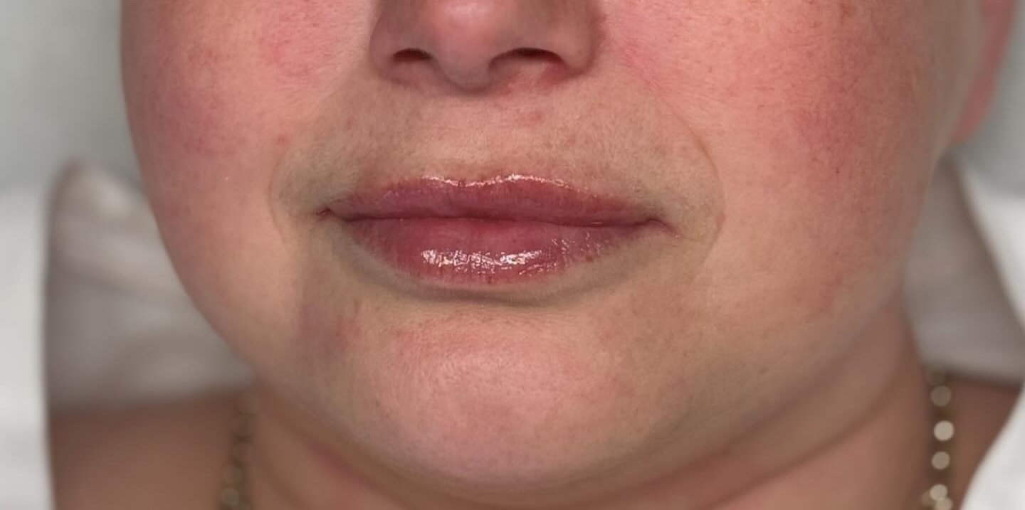 Lip Augmentation — after