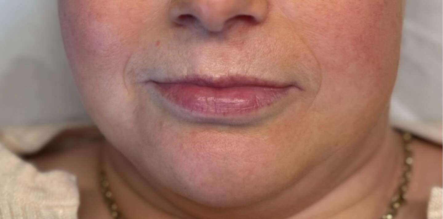 Lip Augmentation — before