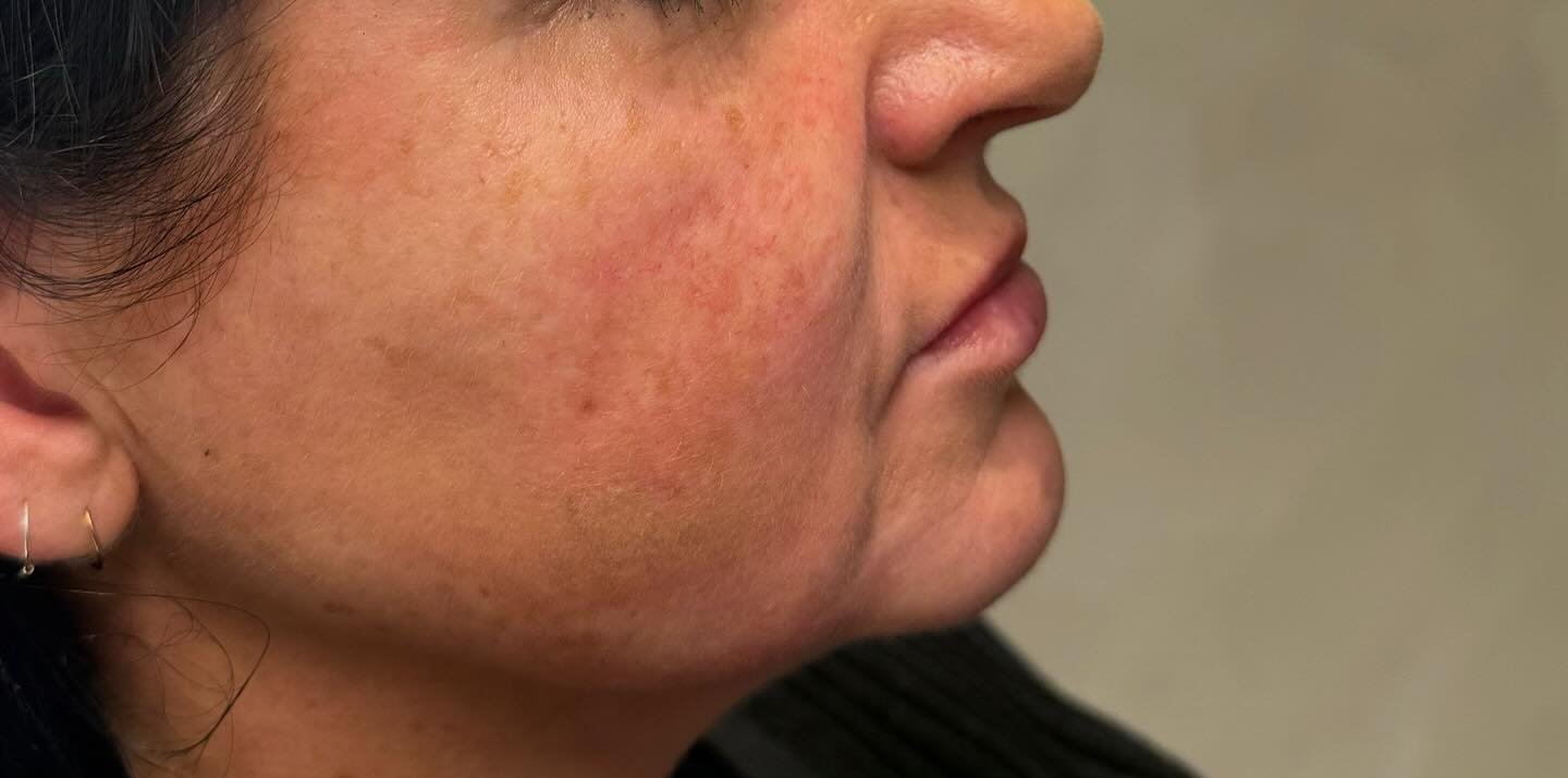 Jawline &amp; Skin — before