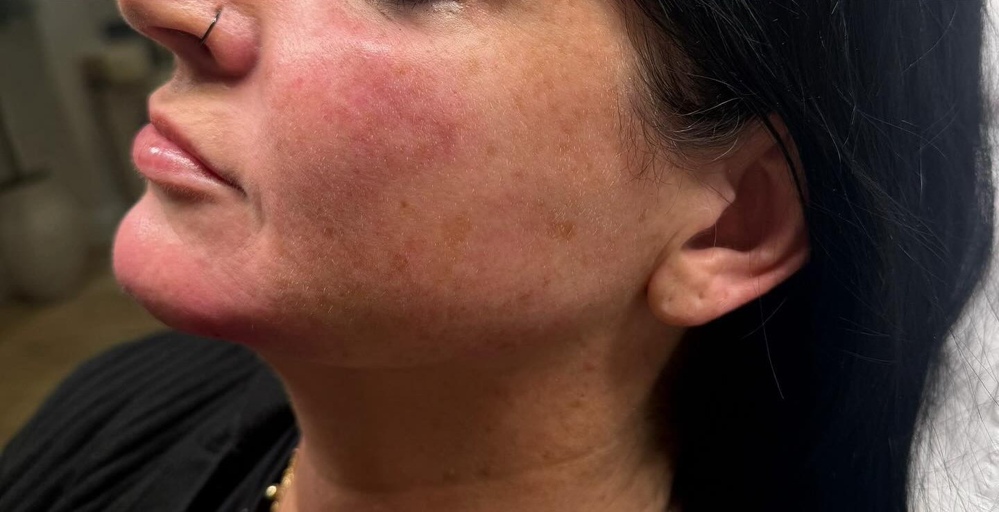 Jawline Contour — after