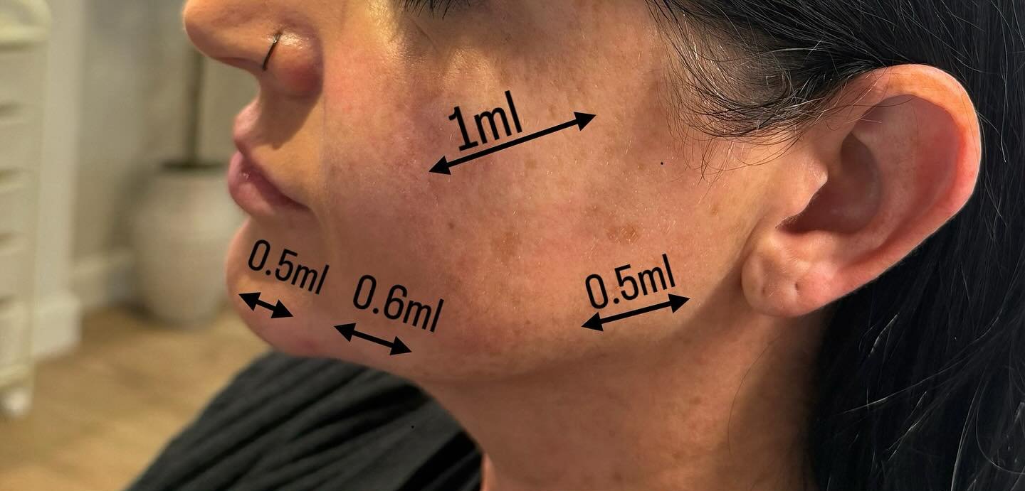 Jawline Contour — before