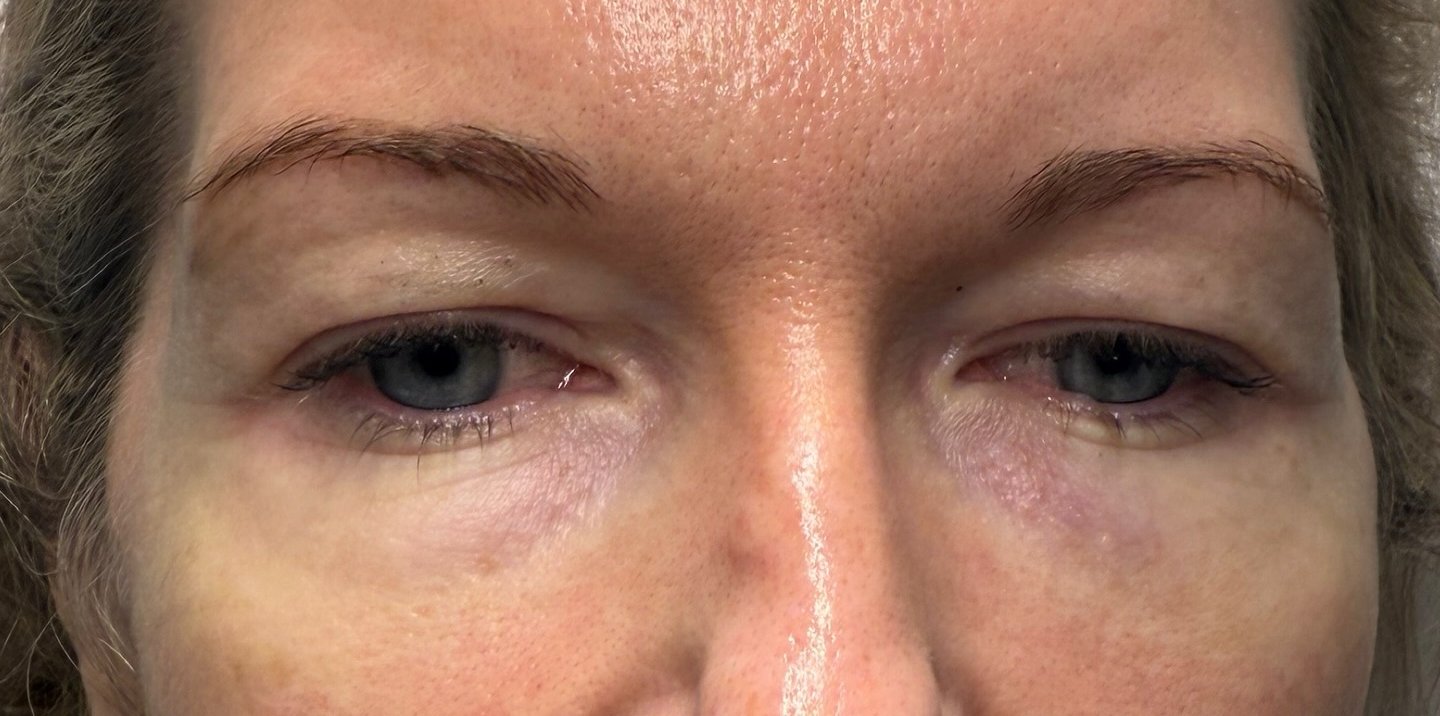 Under-Eye Rejuvenation — after