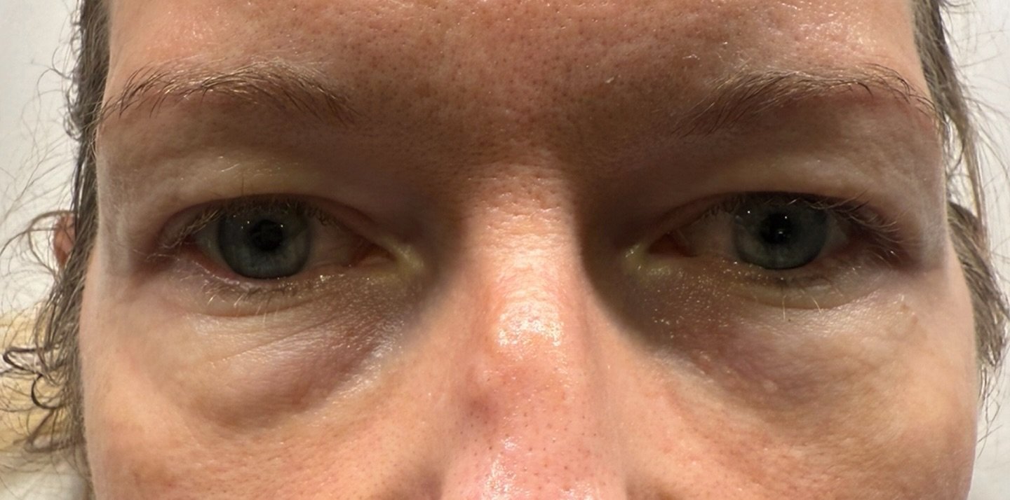 Under-Eye Rejuvenation — before
