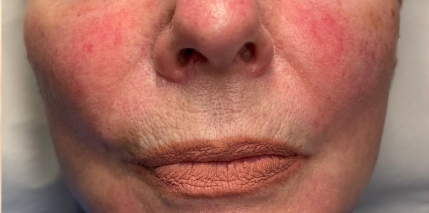 Nasolabial Folds — after
