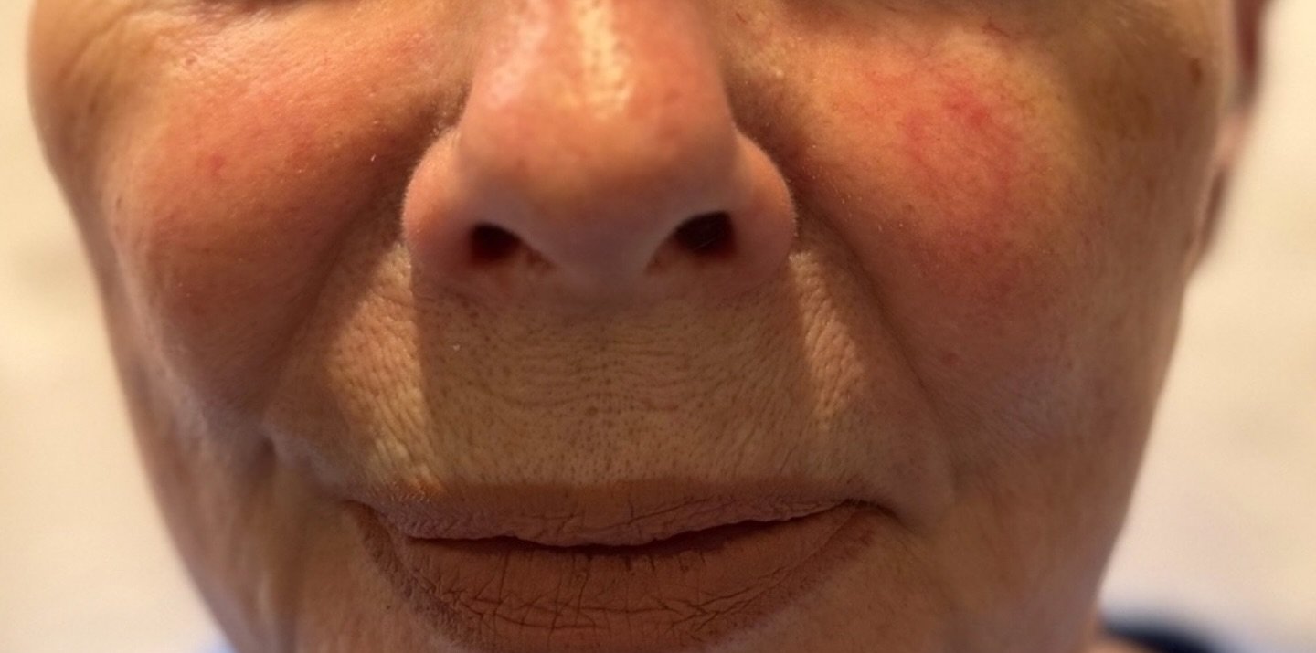 Nasolabial Folds — before