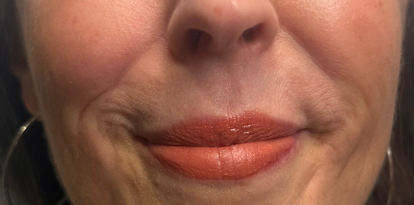 Cheek Filler — before