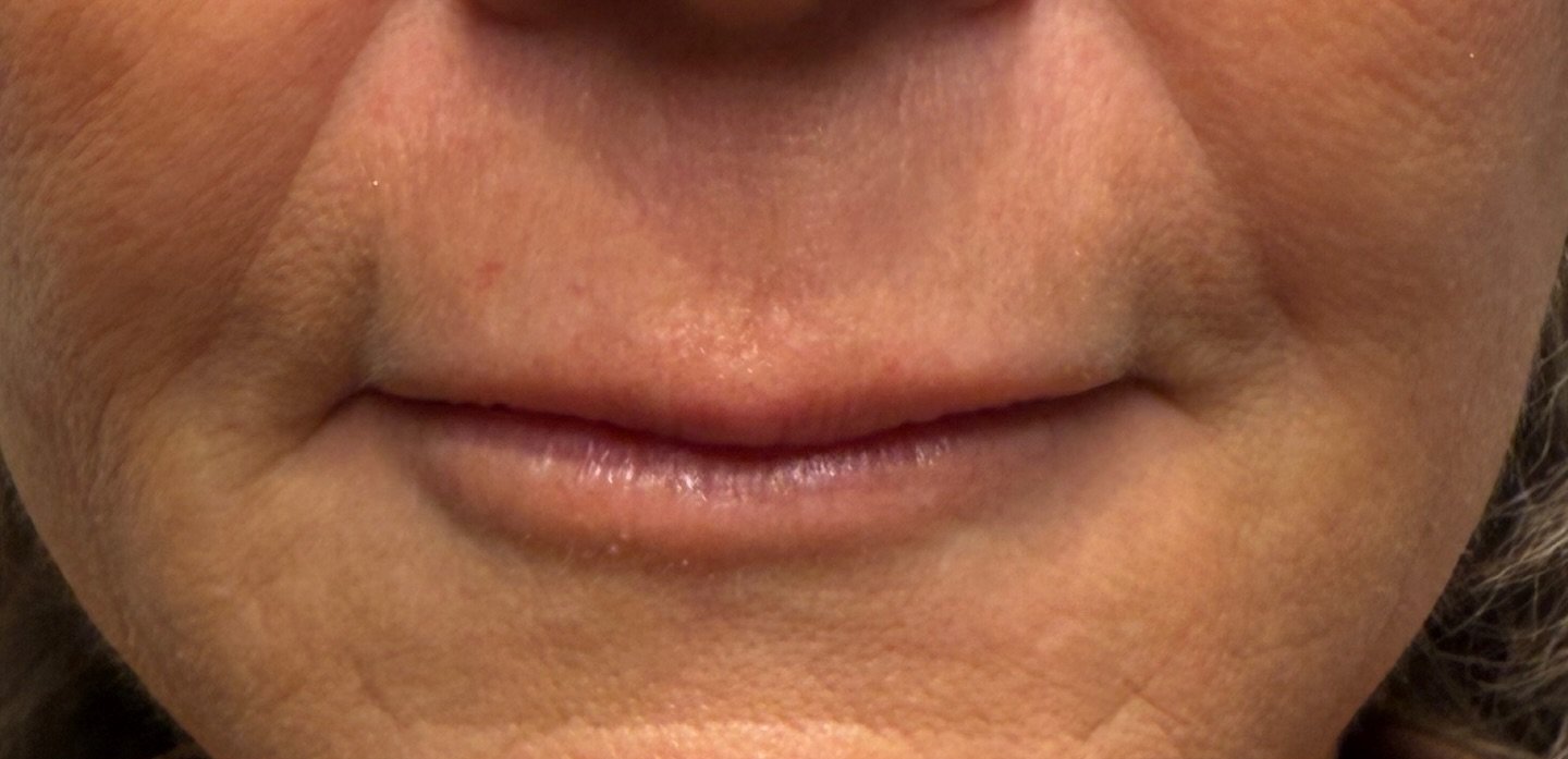 Lip Enhancement — before