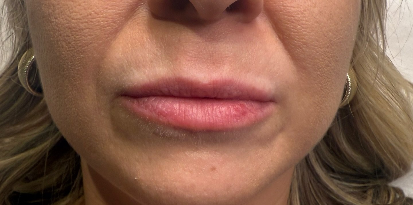Lip Filler — before
