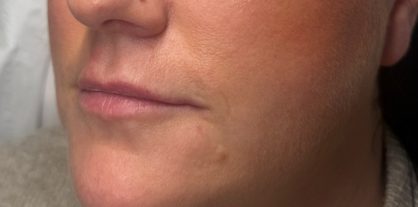 Lip Volume — before