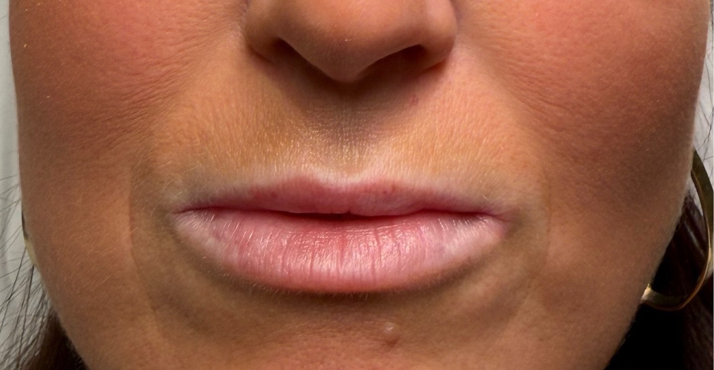 Lip Filler — before