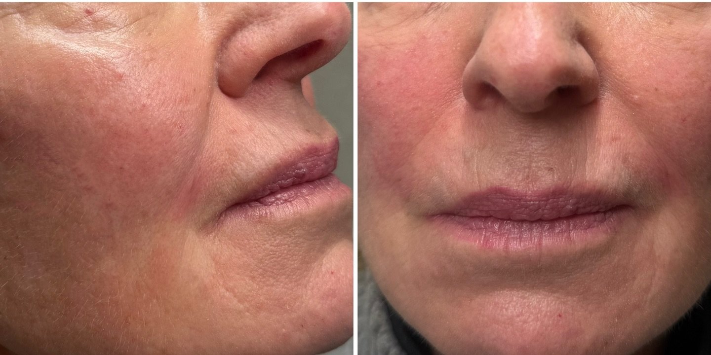 Nasolabial Folds — after