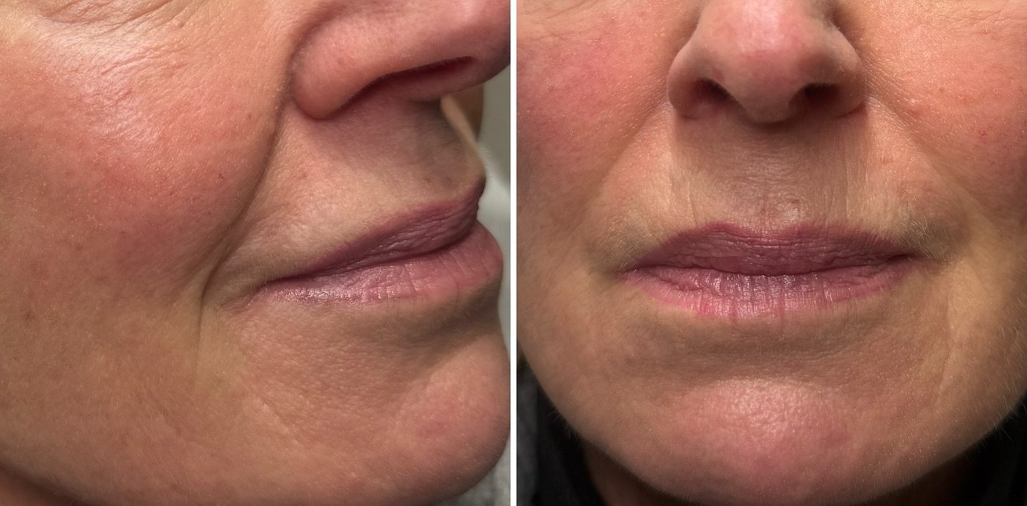 Nasolabial Folds — before