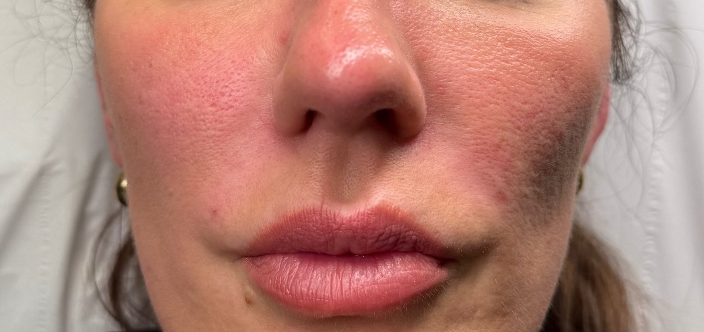 Cheek Filler — after