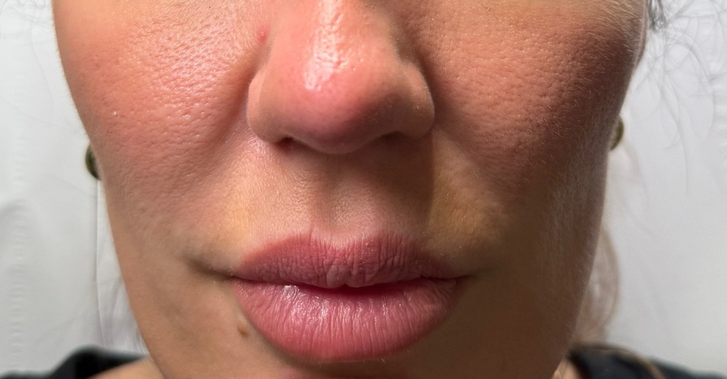 Cheek Filler — before