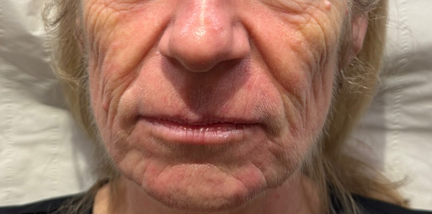 Lip Definition — before