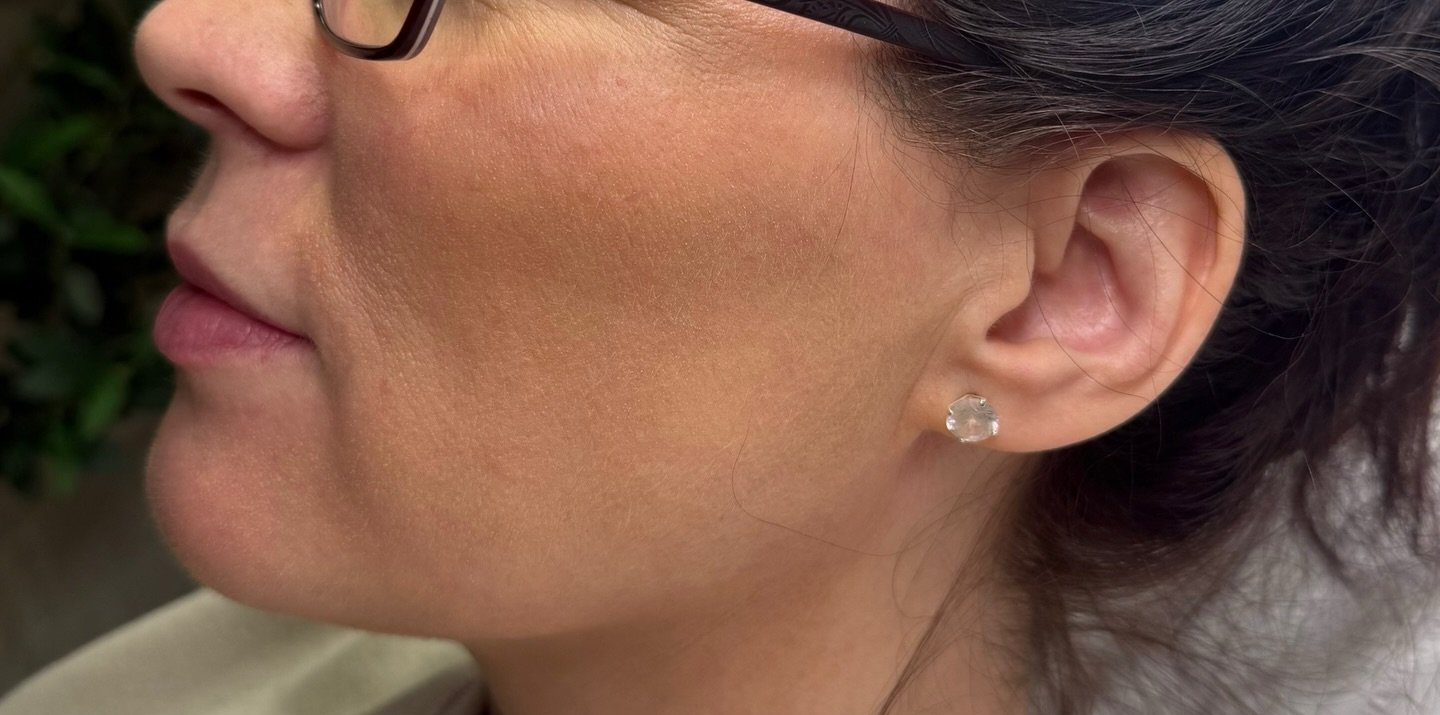 Jawline Definition — before