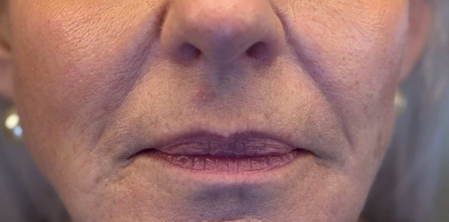 Nasolabial fold filler — before
