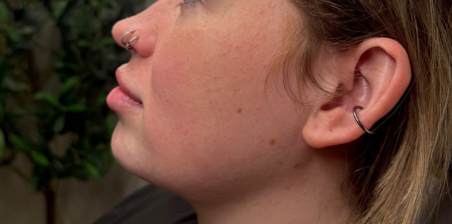 Jawline definition — before