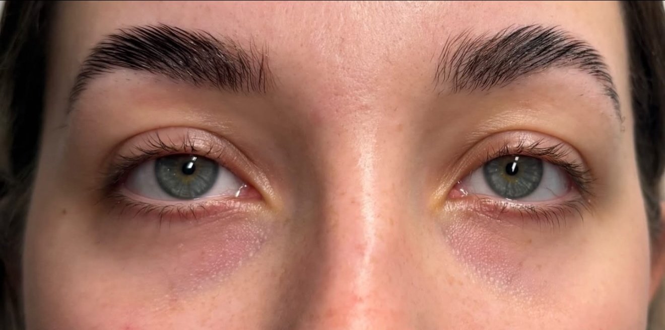 Brow and eye area — before