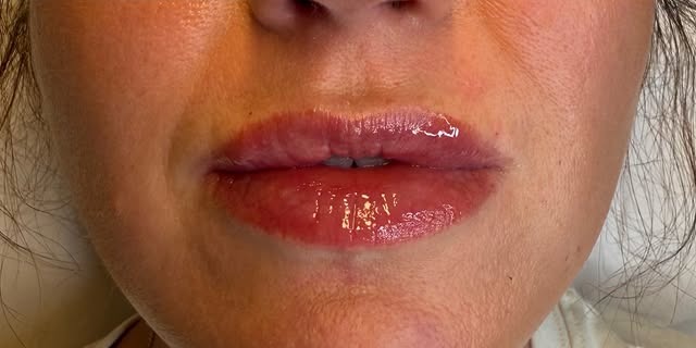 Lip Enhancement — after