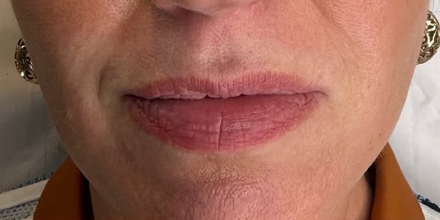 Lip Enhancement — before