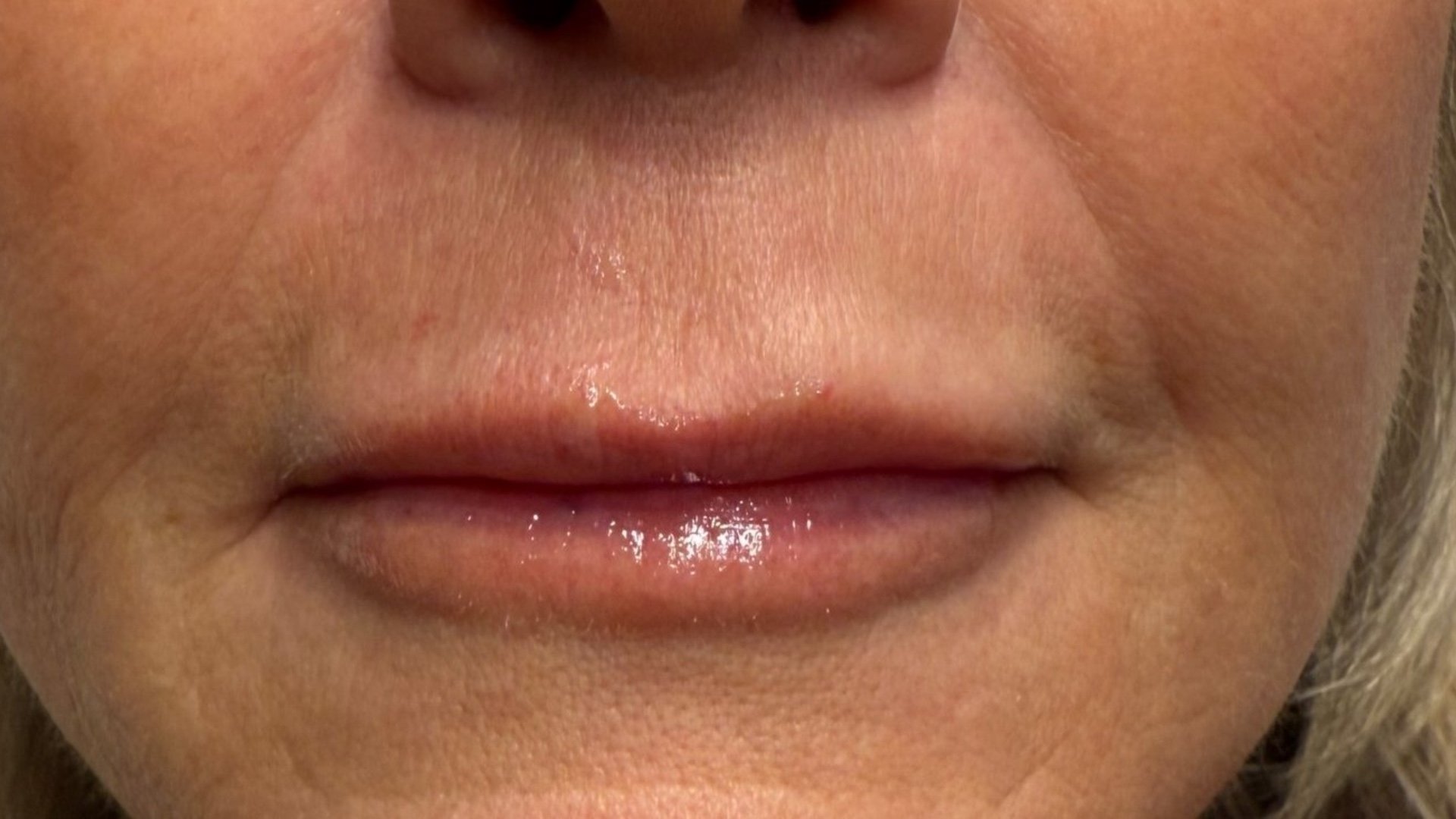 Lip Enhancement — after