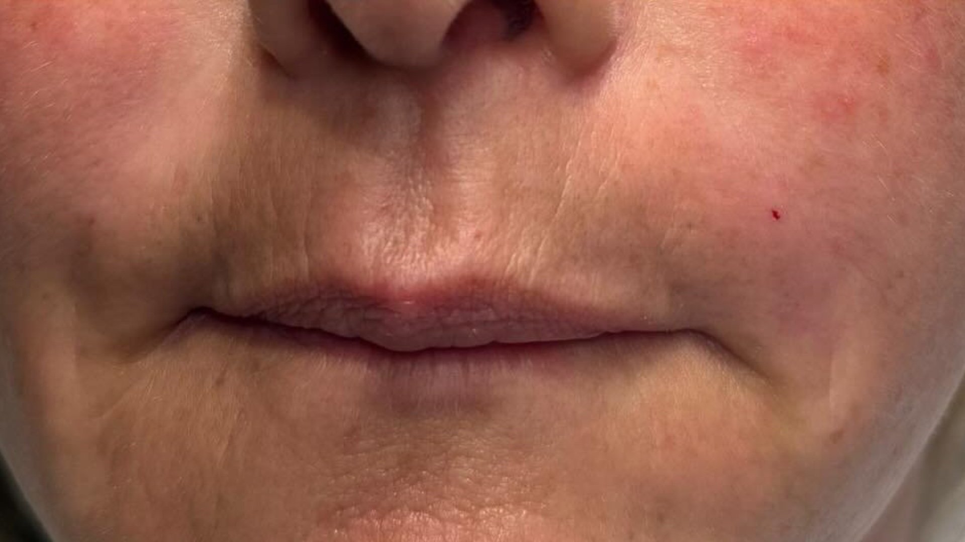 Cheek Contour — after