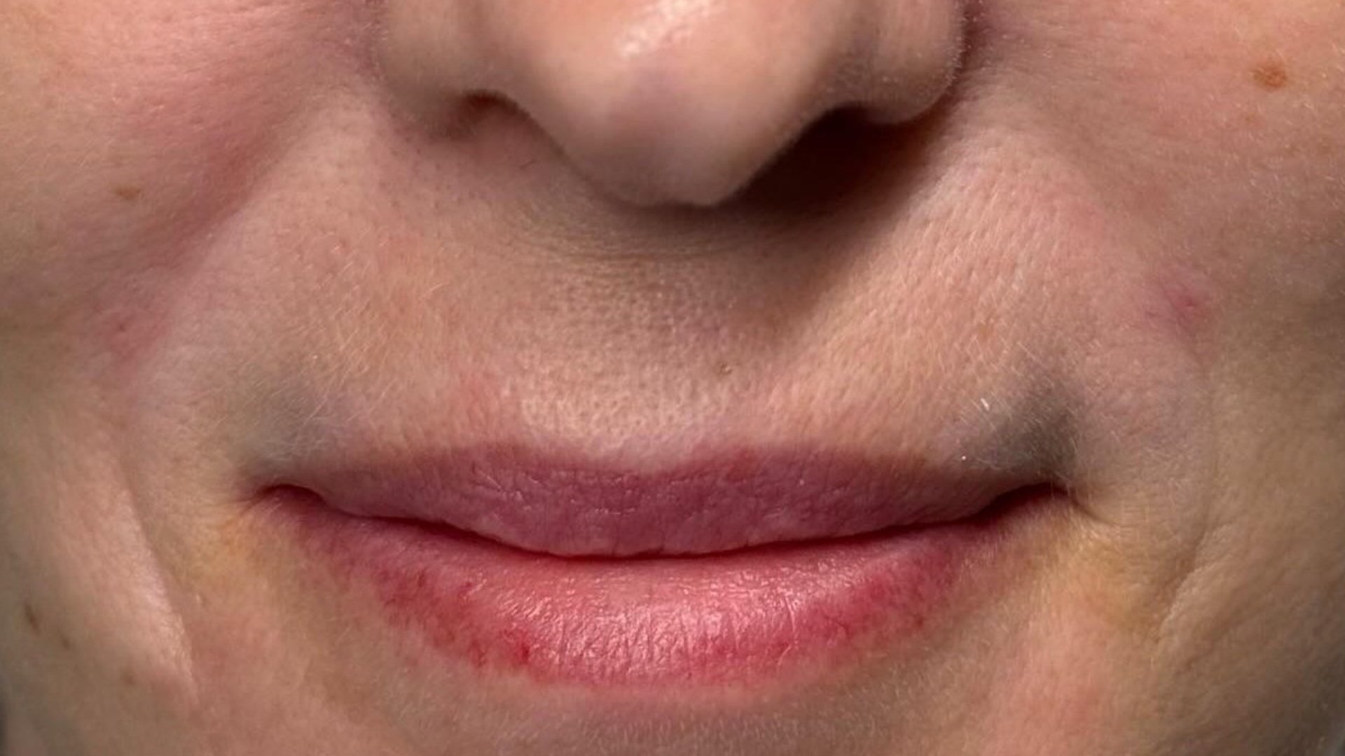Cheek Filler — after