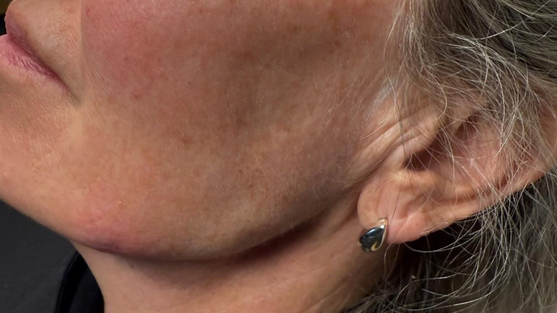 Jawline Definition — after