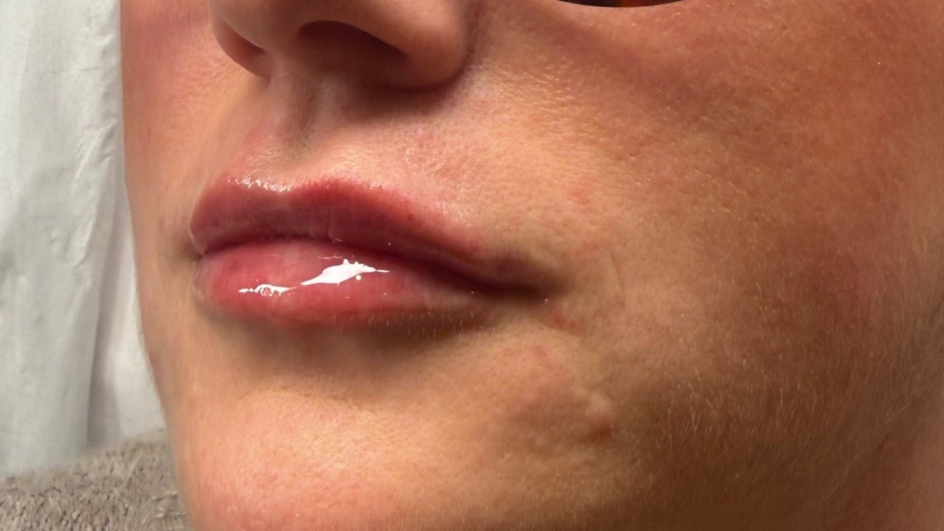 Lip Volume — after