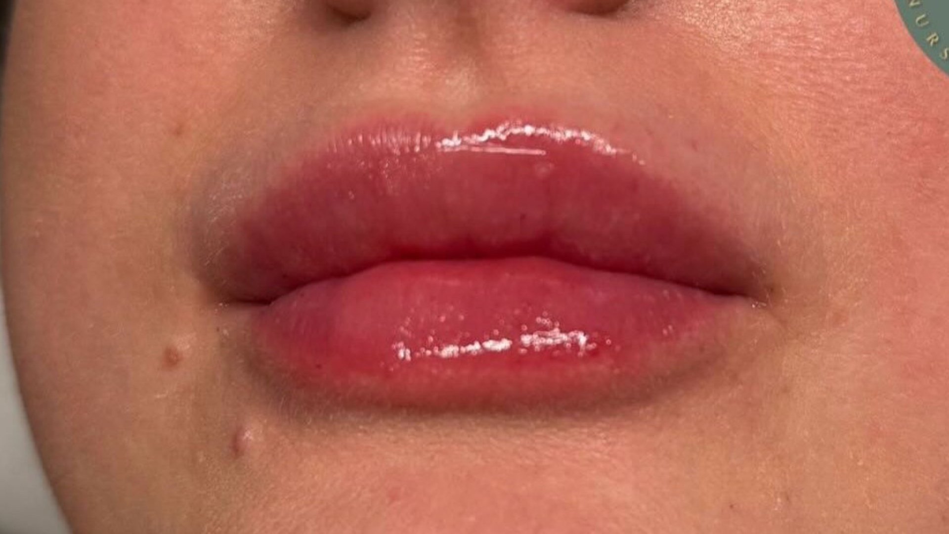 Lip Volume — after