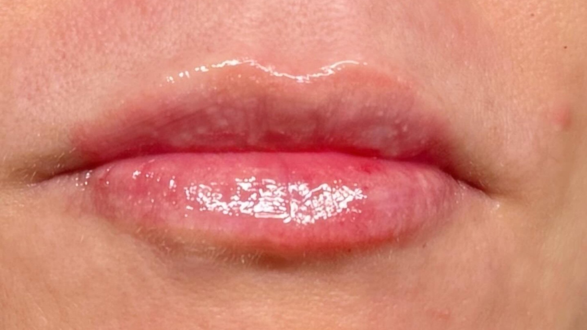 Lip Augmentation — after
