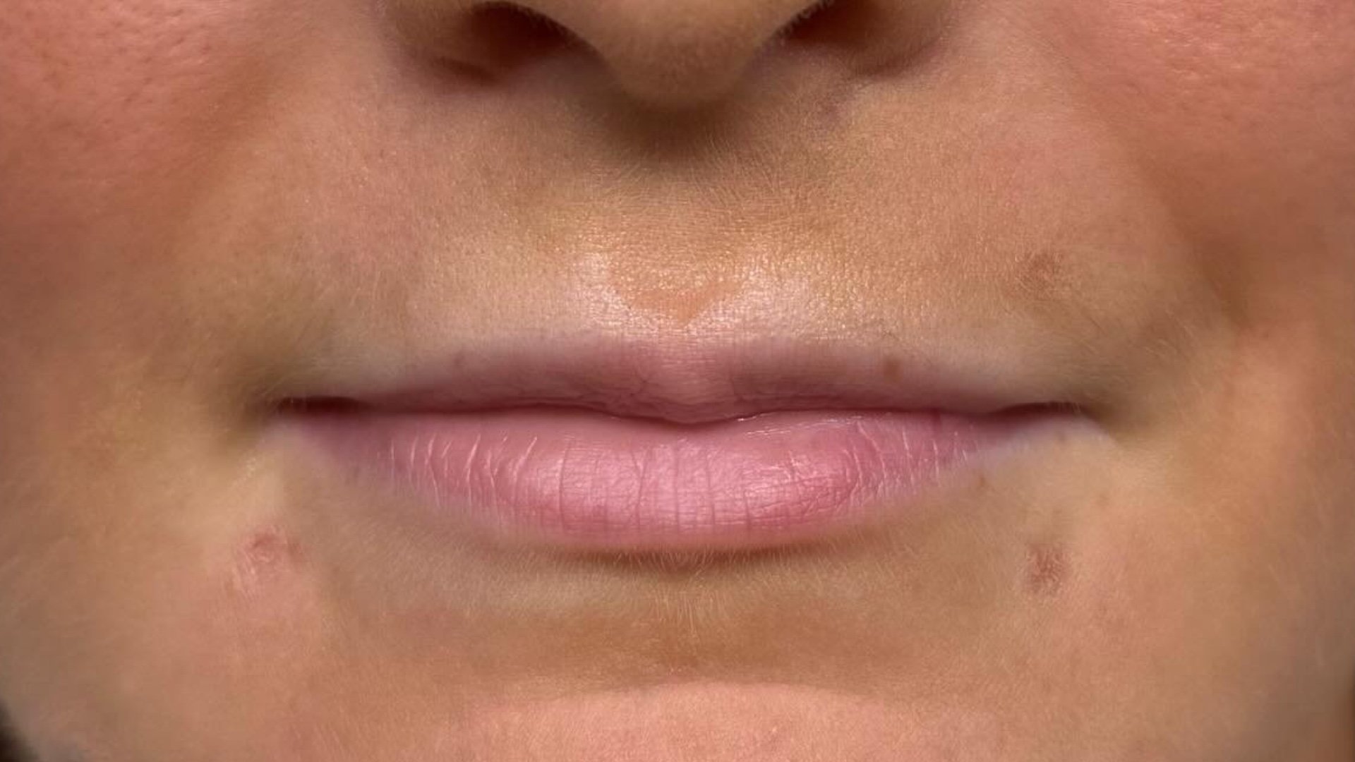 Lip Augmentation — before