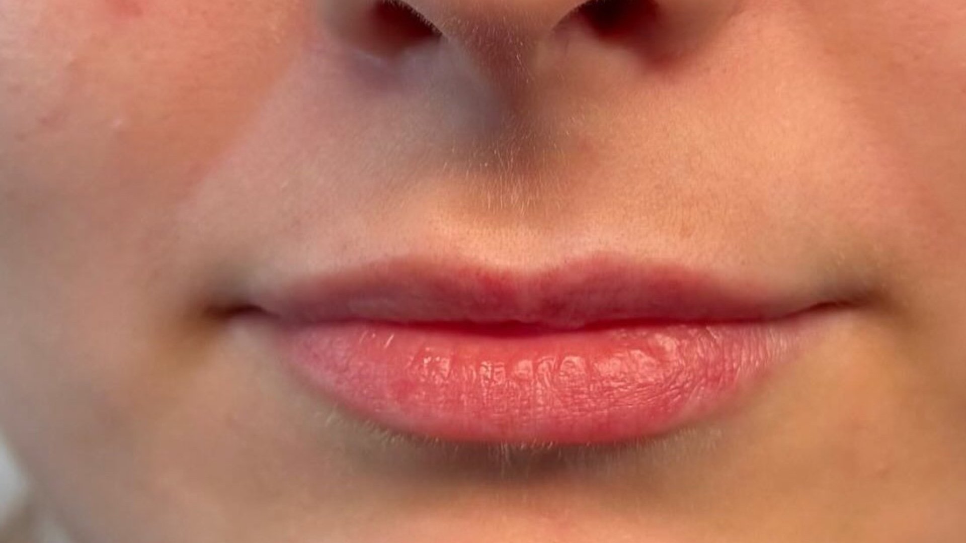 Lip Enhancement — before