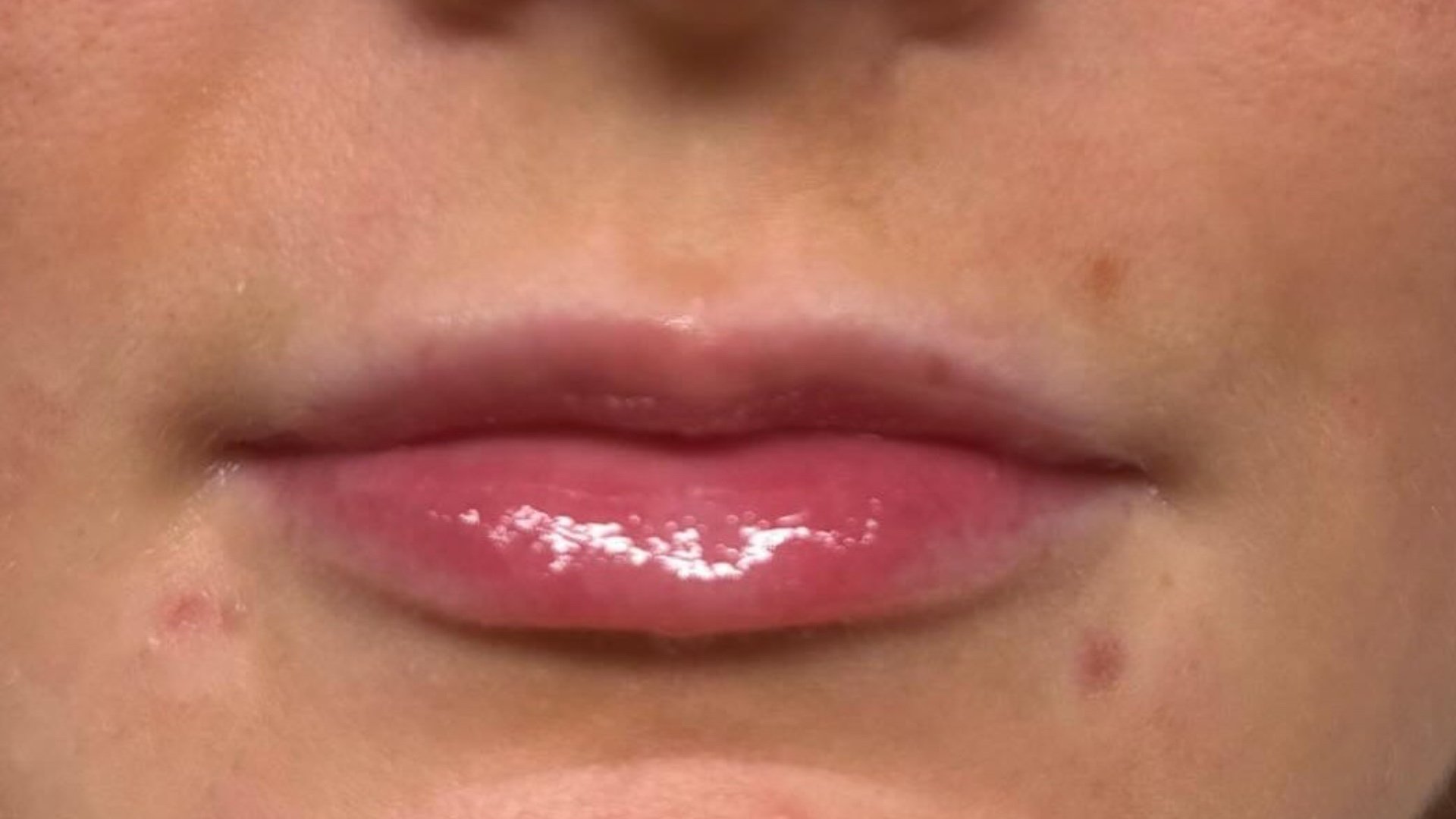 Lip Augmentation — after